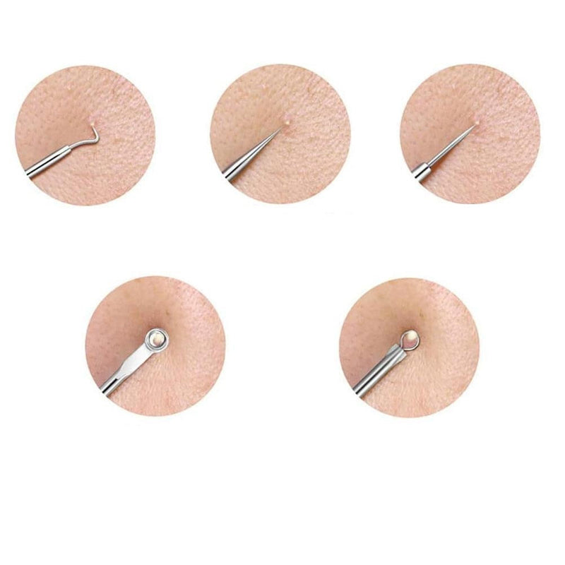 Kit de 4 Crizz™ Ferramentas de Acne Removedor de Cravo Espinha